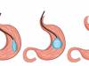 Details & Benefits of Intragastric Balloon Surgery