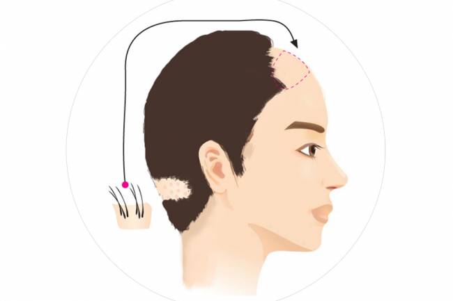 Is the hair transplant good effect? Can judge from these 3 points