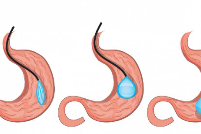 Details & Benefits of Intragastric Balloon Surgery