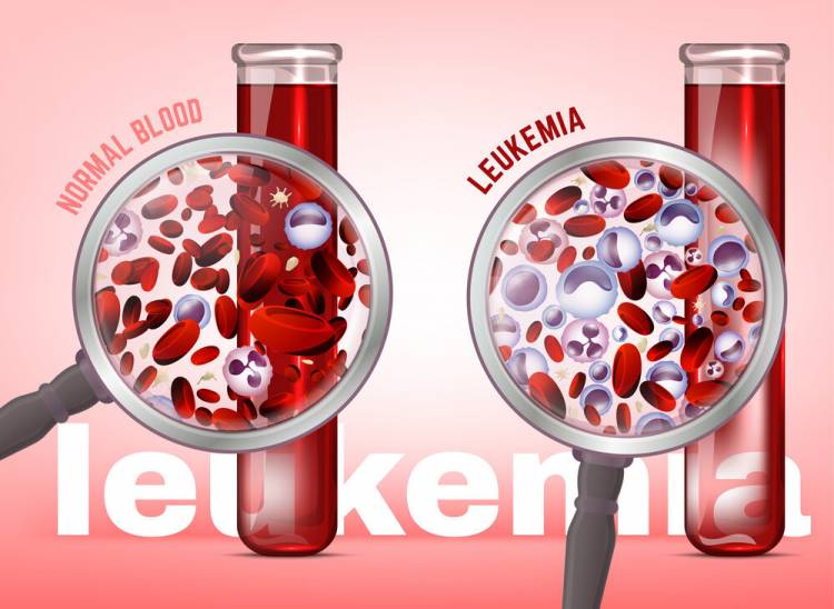 What is Leukemia? Warning Signs and Prevention