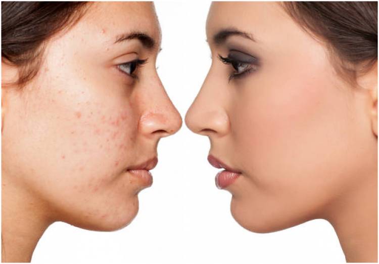 What Are The Types Of Acne Treatment Available?