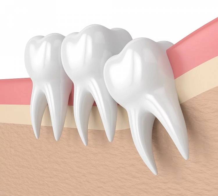 About Orthodontist Dubai Wisdom Tooth Removal